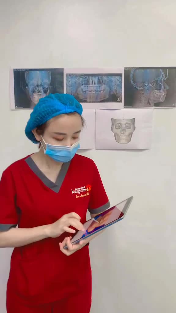 Phẫu Thuật hạ gò má - giải quyết gò má cao + to Kết quả sau 60 phút